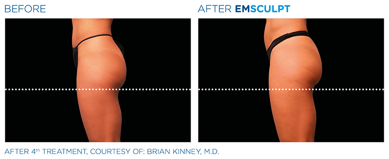 emsculpt treatment results