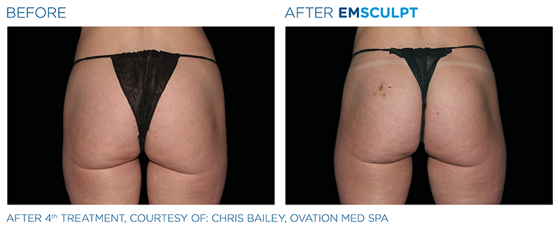 EMSculpt Non-Invasive Fat Reduction