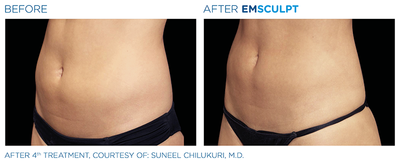 emsculpt results