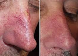 Vascular laser sales